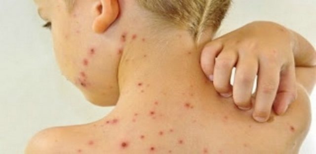 Últimos casos de sarampo no país foram registrados em julho do ano passado (Foto: Reprodução/Sobral Agora)