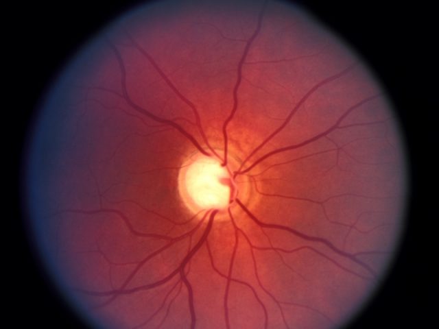 O glaucoma é uma doença do nervo óptico que não apresenta sintomas em sua fase inicial. (Foto: Reprodução/Cultura Mix)