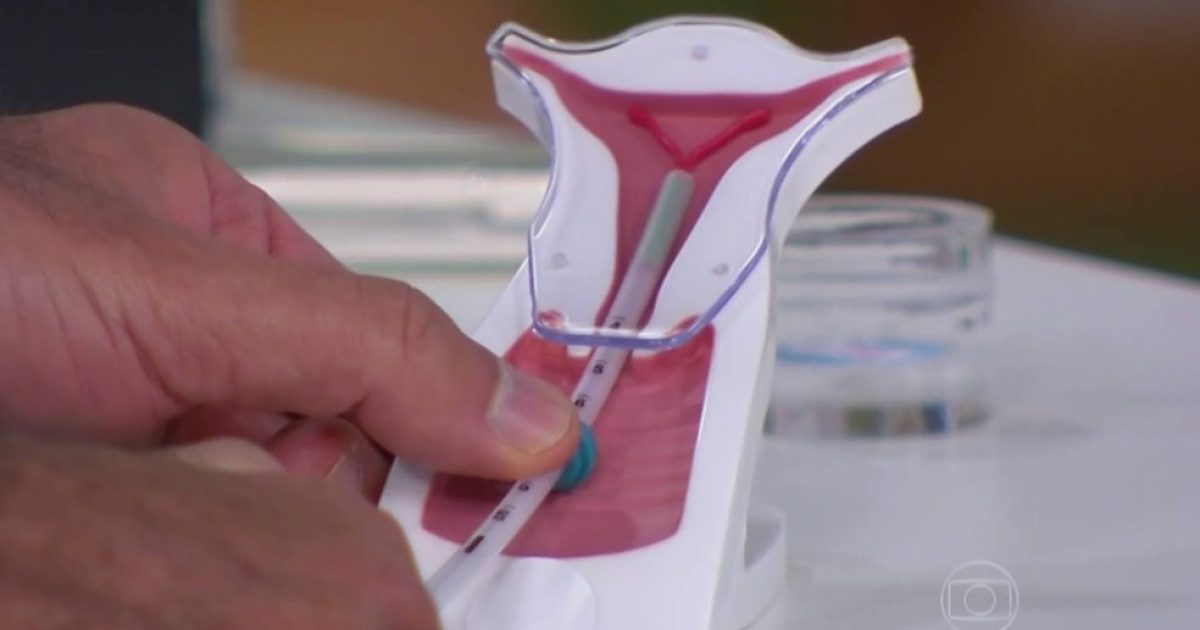 Dispositivo intra-uterino, conhecido como DIU. Foto: TV Globo/Reprodução.