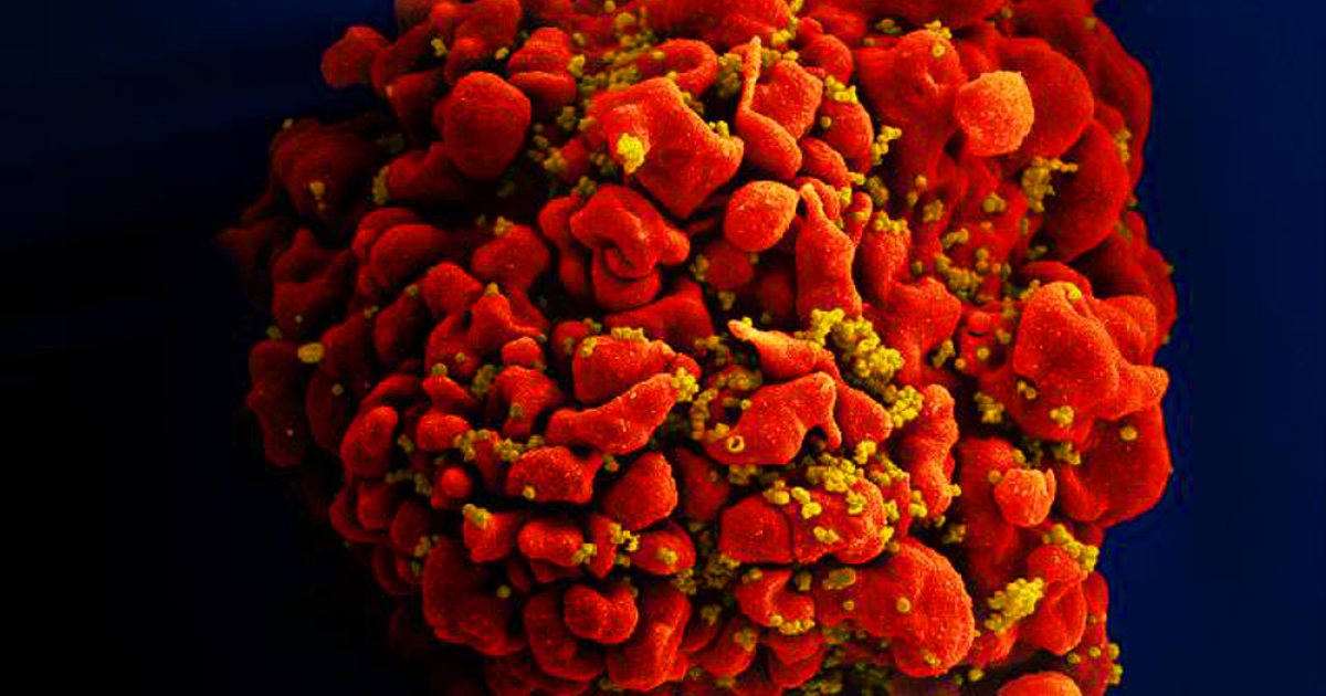 Célula infectada por partículas do vírus HIV, anexas à superfície. (Foto: National Institute of Allergy and Infectious Diseases (NIAID)