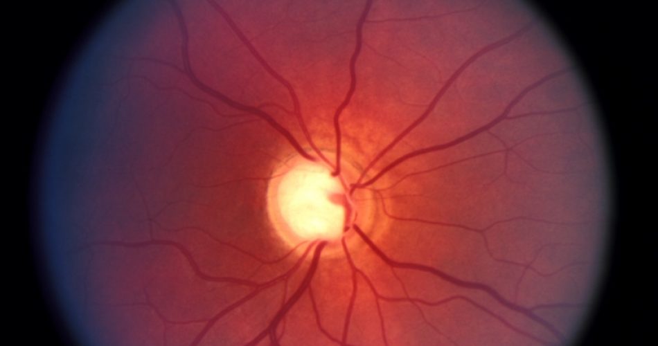 O glaucoma é uma doença do nervo óptico que não apresenta sintomas em sua fase inicial. (Foto: Reprodução/Cultura Mix)